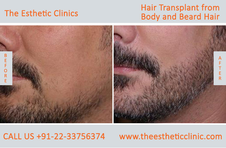 Hair Transplant from Body and Beard Hair before after photos mumba (5)